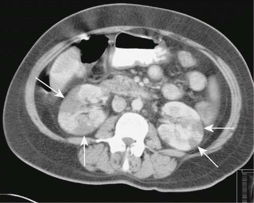 Figure 1. Post-contrast computed tomography of the abdomen at the level of the kidneys demonstrating multiple wedge-shaped, sharply marginated, low-density lesions without contour bulging in both kidneys (arrows), suggestive of segmental renal infarction areas.