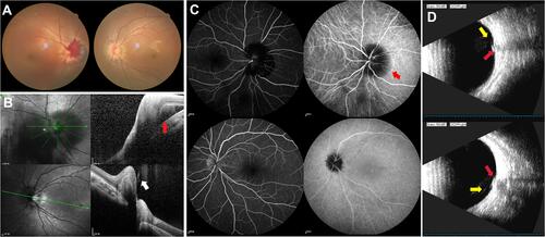Figure 5 Multimodal imaging of Case 3 diagnosed as IHAPSH. (A) Hemorrhage in intrapapillary, peripapillary subretinal in his right eye, and a small tilted optic disc in the left eye. (B) Nasal optic disc elevation with hemorrhage, widening of subretinal space performed by OCT (red arrow); local posterior vitreous attached to the raised nasal optic disc on the contralateral eye (white arrow). (C) Fluorescence blockage due to peripapillary subretinal hemorrhage (red arrow) on ICGA. (D) Incomplete posterior detachment of vitreous body adhered to the bulged optic disc in the right eye confirmed by B-ultrasonography (yellow and red arrow).