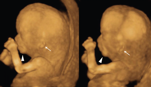 Figure 34.  Micrognathia and lowset ears at 13 weeks of gestation. Both images are from the same fetus. Micrognathia (arrowheads) and lowset ears (arrows) are clearly demonstrated by 3D reconstructed images.