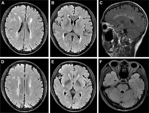 Figure 1 Cerebral magnetic resonance imaging with fluid-attenuated inversion-recovery (FLAIR) showing high-signal intensity lesions in the periventricular white matter (A–C), bilateral centrum semiovale (D), and right external capsule (E), which are not prominent in the anterior temporal poles (F).