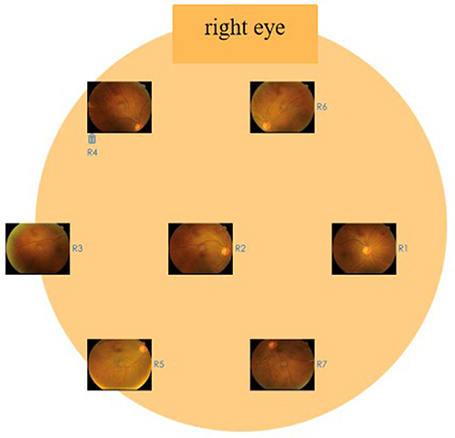 Figure 1 Interface of the fundus picture analysis platform. The general information and fundus picture were uploaded and analyzed on the platform at Sichuan HealthSun Vision Medical Technology Development Co.,Ltd (Sichuan HealthSun Vision).