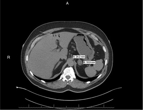 Fig. 2 A non-contrast CT abdomen (axial view) showing portal venous gas within the left lobe of the liver (white arrow). Also, a non-specific left adrenal nodule measuring 24.2 mm×18.9 mm is visualized.