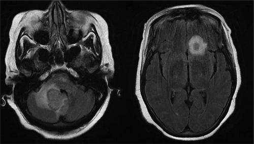 Figure 2. (left) Repeat magnetic resonance imaging (MRI) (12/19/19) showing an increase in the size of the right cerebellar peduncle lesion with surrounding edema with mass effect causing partial displacement of the fourth ventricle. (right) Repeat MRI showing increase in left frontal lobe lesion that has also increased in size with surrounding edema