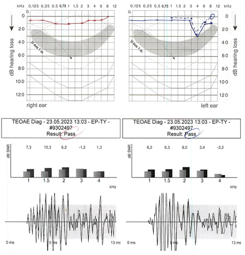 Figure 4 Sensorineural hearing loss at the left inner ear in a 20-year old professional violinist. History of 16 years of playing and > 20,000 cumulative practice hours (average 3–5h/day). Above: Pure-tone audiometry with left-sided noise induced c5-dip (ie, 4 kHz loss) caused by asymmetric long-term exposure to higher loudness levels of own instrument. Below: Transitory evoked otoacoustic emissions (TEOAE) with corresponding evidence of damage to the outer hair cells.