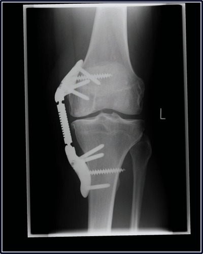 Figure 4 Weight-bearing radiograph of left knee demonstrating successful initial KineSpring® System.