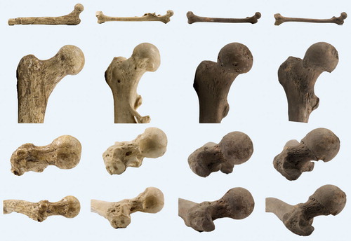 Figure 22. Evolution of the Hominin femur from left to right: Lucy (Australopithecus afarensis, 3.2 my); Java Man (Homo erectus, 1.5 my, note traumatic defect on anterior femoral head and myositis ossificans-like lesion on medial diaphysis); Homo sapiens female; H. sapiens male. H. erectus and both H. sapiens femora are from Dubois collection. Lucy femur has no femoral condyles, anteversion of femoral neck is therefore uncertain. Note variable rotation on AP views (2 top rows) giving variable impression of femoral neck length. Also note coxa rotunda in female and coxa recta with high anteversion in male H. sapiens. Scales are approximate.