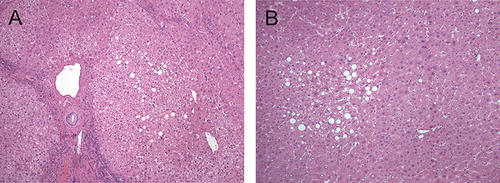 Figure 2 The degrees of surrounding nontumoral liver tissue steatosis in MAFLD-related HCC with liver cirrhosis background (A) and non-cirrhosis background (B), which are less than 30% (hematoxylin and eosin stain, original magnification ×100).