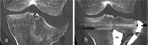 Figure 1. A coronal plane of: a) The preoperative image; b) The postoperative image.