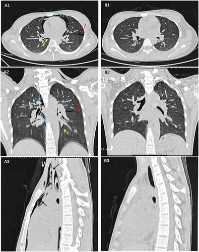 Figure 2 In (A1-3) a large amount of gas has collected in the pericardium (green arrow), in the interstitial lung (red arrow), in the bronchial sheath (blue arrow), and in the pulmonary vascular sheath (yellow arrow), before entering the mediastinum (black arrow), which is a unique manifestation of diabetic ketoacidosis with pneumomediastinum. (B1-3) shows that there is no accumulation of gas in the pericardium, interstitial lung, bronchial and pulmonary vascular sheath, and mediastinum after correction for acidosis and hyperglycemia.
