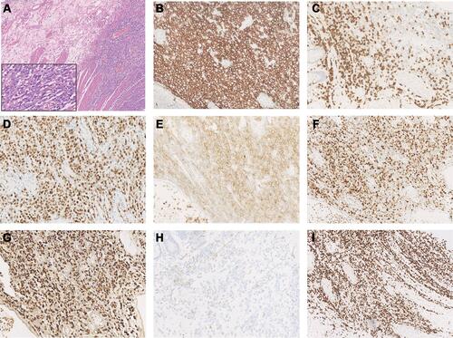 Figure 2 Immunohistochemical staining of diffuse large B-cell lymphoma tissue sample. Immunohistochemical staining of H&E (A) and Ki67 (I), positive for CD20 (B), MUM1 (D), CD10 (E), Bcl-6 (F), EBER (G) and negative for CD3 (C), PD-1 (H) (A: H&E×100, inset: H&E×400, B–H: ×200, I: ×100).