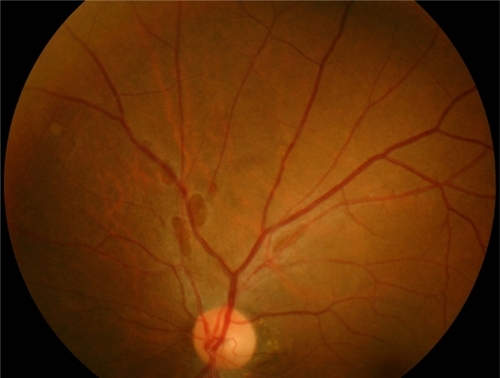 Figure 1 Several spots similar to retinal hemorrhage were seen along with the vessels superior to the disc.