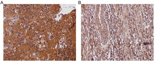 Figure 5 Bladder carcinoma TM immunoexpression between two independent patient tissue cores both graded III and staged 3. Left micrograph (A) HBlaU066Su01 TMA, position A2, 75-year-old male, grade III, stage 3, T3N0M0, malignant bladder cancer; right micrograph (B), HBlaU066Su01 TMA, position B9, 55-year-old male, grade III, stage 3, T3-M0, malignant bladder cancer. Tissue cores probed anti-TM and counterstained with hematoxylin (magnification 200x). The bladder cancer patient whose biopsy is described in the left micrograph (with evident TM immunoexpression (score ≥3.0)) is alive 82 months after surgery. However, the bladder cancer patient whose biopsy is described in the right micrograph (with low TM immunoexpression (TM score <3.0)) only survived 9 months following their surgery.