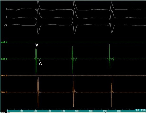 Figure 8 Intracardiac electrogram of junctional rhythm after radiofrequency ablation of the slow pathway.