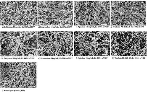 Figure 2. Scanning electronic microscope images showing the fibrin network structure in selected dabigatran- (a,b), apixaban- (c,d), rivaroxaban- (e,f), and warfarin-treated (g,h) patients with different fibrin network permeability (Ks) as well as NPP for comparison (i). The respective DOAC concentration or PT-INR is provided below each image.
