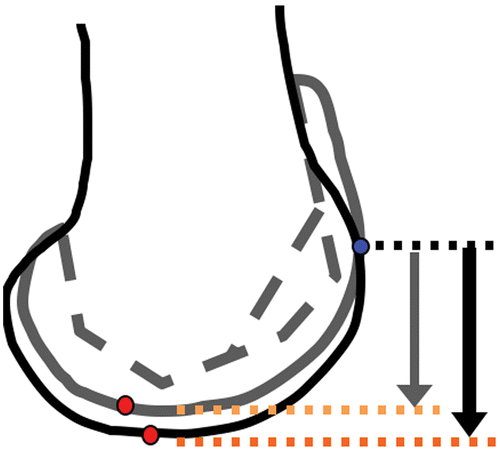 Figure 12. When the joint line is raised due to under-resection of the tibia (whether intentional or unintentional) and the femoral component is consequently positioned more proximally, the patella contacts the femoral component more distally (relative to the notch or distal condyles) due to the constant length of the patellar tendon. However, relative to the coordinate frame of the femoral bone (to which the femoral marker array is attached), the position of the patella remains relatively unchanged in extension (blue dot, anteriorly). In flexion, the patella “rounds the corner” sooner than in the intact knee (red dots, distally). Relative to the femoral coordinate frame, this paradoxically causes the patella to be more flexed in early flexion and more proximal and posterior in later flexion relative to the pre-arthroplasty kinematics (Figure 9). [Color version available online.]