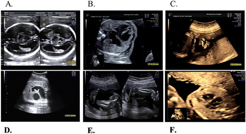 Figure 2. Pictures of abnormal ultrasound result. (A) Broadening of lateral ventricle. (B) Ventricular septal defect. (C) Cleft lip and palate. (D) Dilatation of the bowel. (E) Varus foot. (F) The left ventricle exhibited hypoplasia.