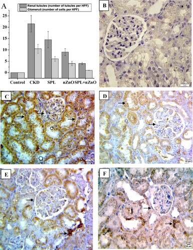 Figure 4. Immunohistopathological examination for β-catenin expression in kidney tissues. (A) The score of β-catenin in all studied groups, (B) negative expression for beta catenin (control group, 400×), (C) marked cytoplasmic expression for beta catenin in both renal tubules and glomeruli (CKD group, 200×), (D) moderate expression of β-catenin in SPL group (200×), (E) mild expression of β-catenin in ZnO-NPs group (200×), and (F) mild expression in SPL + ZnO-NPs group (200×). a: significant difference versus control, b: significant versus CKD, c: significant versus SPL, d: significant versus ZnO-NPs at p < 0.05.
