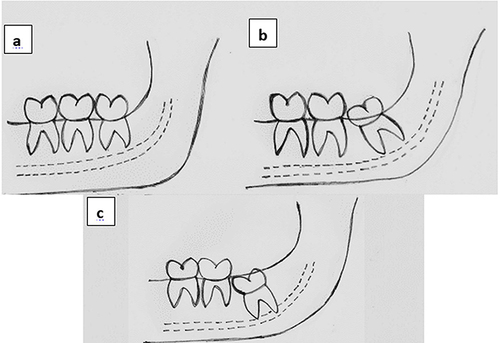 Figure 2 Pell and Gregory classification (Impaction Depth) (a) Level A. (b) Level B. (c) Level C.