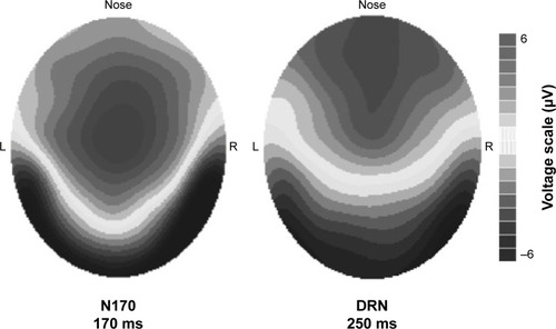 Figure 3 Topographic voltage maps of the N170 and the DRN component shown with the same voltage scale in AMD patients before treatment.