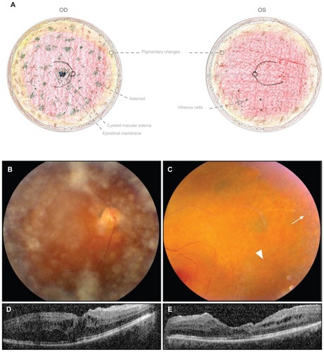 Figure 2 Twin A displays stage III ADNIV at the age of 49 years. (A) Fundus drawings record 1+ epiretinal membrane, asteroid, and cystoid macular edema OD; attenuated vessels and vascular remodeling OS; and peripheral pigmentary changes and mild vitreous cells OU. (B) Fundus photograph OD shows asteroid in the vitreous. (C) Fundus photograph OS shows a sheathed vessel, pigmentary changes (arrow) in the peripheral macula, and vascular remodeling (arrowhead). (D and E) Optical coherence tomography of the foveas shows cystoid macular edema.