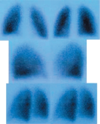 Figure 2 Perfusion scintigraphy post-7-month.
