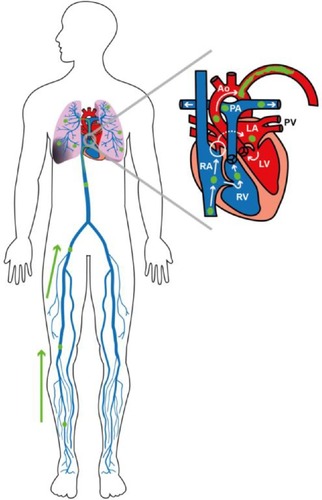 Figure 1 Schematic representation of deep venous thromboembolisms in the legs, bilateral pulmonary embolisms, and a paradoxical embolus in the left subclavian artery through a patent foramen ovale.