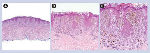 Figure 2. Pigmented spindle cell nevus.(A) Circumscribed and symmetric lesion (40×). (B) Mostly junctional nevus composed of heavily pigmented spindled melanocytes (100×). (C) Heavily pigmented and spindled melanocytes without cytologic atypia (200×).