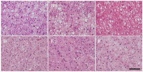 Figure 2. Microscopic findings of frontal lobe HE staining in patients with V180I genetic Creutzfeldt–Jakob disease (CJD) (A: patient 1, B: patient 2, C: patient 3, D: patient 4, E: patient 5, F: patient 6). Spongiform change is noted. However, neuronal loss and gliosis are mild compared to in sporadic CJD (MM1-type, MM2C-type). Even in patients 5 and 6, neurons remain. Scale bars: 100 μm HE, hematoxylin and eosin.