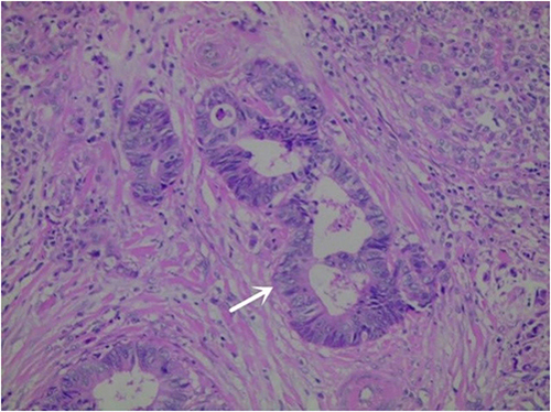 Figure 3 Heterotypic glands fused, partially ethmoidal, with marked interstitial fibrosis. The arrow indicates Cribriform heteromorphic cell fusion.