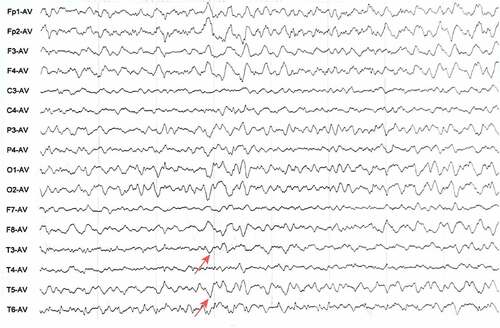 Figure 3. EEG results of the patient. The results showed diffuse slow waves with sharp waves and three-phase waves.