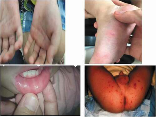 Figure 2. Some clinical symptoms of patients with HFMD in Haiphong Children’s Hospital