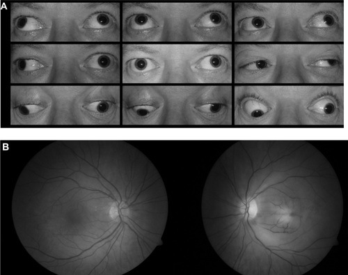 Figure 3 Ocular motility and fundus photographs for Case 1. (A) Nine positions of gaze. Eye movements in the right eye were full. There is complete loss of adduction of the left eye. (B) Fundus photographs.