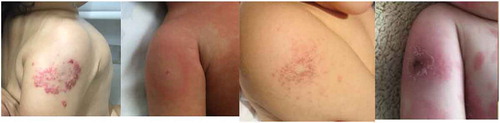 Figure 2. Erythema in BCG in Kawasaki Disease, note the variety of lesions of this useful diagnostic sign.