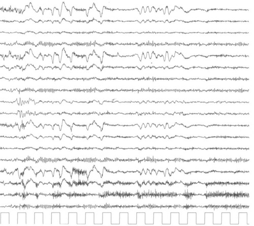 Figure 1 A portion of the electroencephalogram report is shown. Note the presence of background alpha activity and rapid rhythms on frontocentral regions, bilaterally.