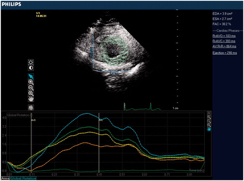 Figure 2. Measurement of apical LV rotation via speckle tracking analysis.