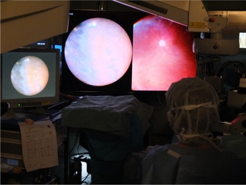 Figure 1 Both the endoscopic image (left) and the wide-angle viewing image (right) are integrated on the large 3D monitor that is placed at the foot of the bed. The small conventional monitor for the endoscope is placed on the left side of the surgeon.