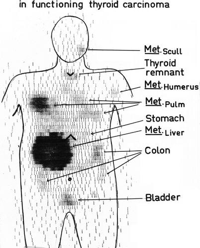 Figure 8.  Whole body scanning of 131I uptake in a 52 year old man with metastatic thyroid cancer. Metastases to the liver, the lungs and the skeleton are demonstrated.