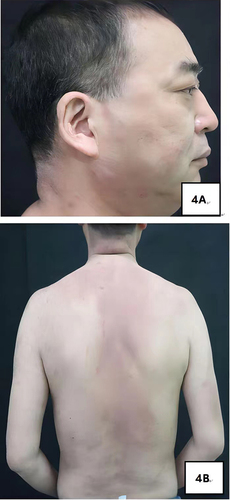 Figure 4 Lesion manifestations after 3 months of treatment. (A and B) After 6 days of treatment, the skin lesions improved and partially resolved, with mild lesions remaining and post-inflammatory hyperpigmentation.