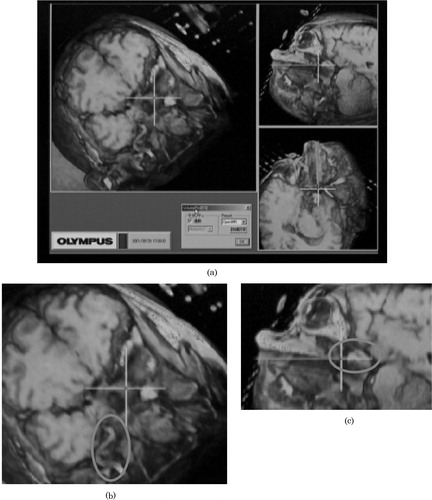 Figure 3. (a) The volume-rendered sectional images generated from open MR data. The cross-hair represents the tip position of the endoscope. (b) The overlaid ellipse encloses the vessel around the tumor. (c) The overlaid ellipse encloses the remaining tumor.