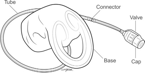Figure 1 The vaginal bowel control (VBC) insert.