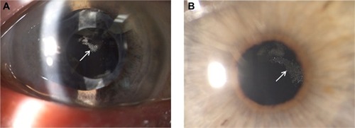 Figure 1 IOL opacification after DSAEK (Case 4).