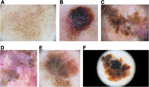 Figure 2 Lentigo maligna(LM)/LM melanoma (LMM) dermoscopic findings. (A) Facial LM with an annular-granular pattern consisting of brown dots scattered around adnexal openings. (B) LM showing a large blotch with the blue-black sign. (C) LM on the scalp with follicle obliteration and central regression (gray peppering or granularity). (D) Facial LM with an annular-granular pattern around adnexal openings and follicle obliteration. (E) Brown lines coalescing to form rhomboids (angulated lines) around adnexal ostial openings at the periphery of this LM. Also, an asymmetric distribution of pigment surrounding the follicular openings can be seen. (F) Extrafacial LM with presence of network and atypical dots. Note the absence of adnexal openings in extrafacial skin.