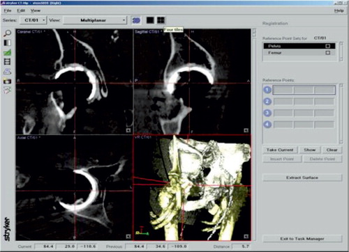 Figure 3. Screen-capture image showing determination of the spatial orientation of the cup using the Stryker Hip Navigation System software.