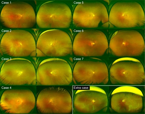 Figure 5 Family history of patients with radial FAF.