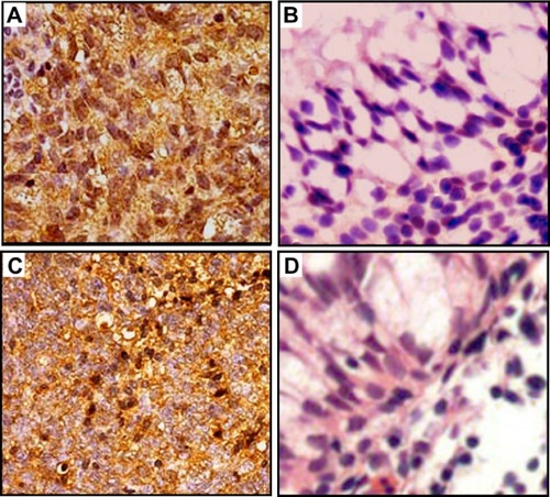 Figure 1 Immunohistochemical staining of MMP-1 and PAR-1 proteins in tumor cells of patients with NPC (A and C, respectively) and noncancerous nasopharyngeal tissues (B and D, respectively). Intense staining of MMP-1 and PAR-1 is seen in the cell membrane and/or cytoplasm of tumors cells and is intensive in NPC tissues (A and C); in contrast, negative immunostaining of MMP-1 (B) and PAR-1 (D) was observed in the noncancerous nasopharyngeal tissues.