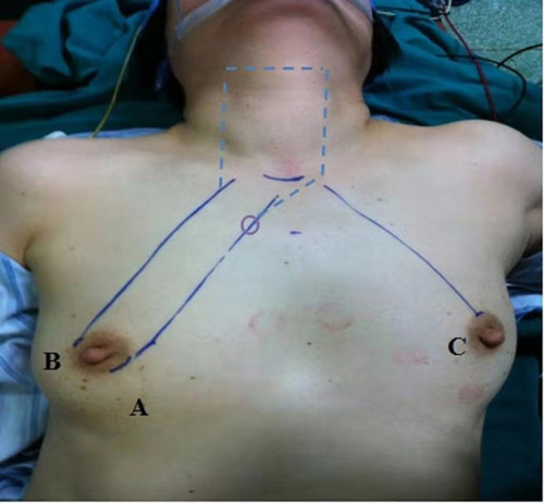 Figure 1 Incisions made around areolas: a one 10-mm incision for endoscopy, b one 5-mm incision for separating pliers and c one 5-mm incision for Harmonic scalpel.