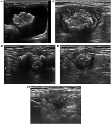 Figure 2. Gradual reduction of papillary thyroid macrocarcinoma after two sessions of RFA (A) Initial ultrasonography (US) of a 77-year-old woman revealed 8.0 cm predominantly cystic mass in the left thyroid gland. (B) After first RFA, US revealed a smaller but persistent, 2.4 cm ill-defined ablation zone in the left thyroid gland. (C) After second RFA, US revealed a smaller, 1.9 cm ill-defined ablation zone in the left thyroid gland. (D) At 12-months follow-up after two sessions of RFA, US revealed a smaller, 1.7 cm ill-defined ablation zone in the left thyroid gland. (E) At 18-months follow-up, US revealed a smaller with decreased calcification, 1.4 cm ill-defined ablation zone in the left thyroid gland.