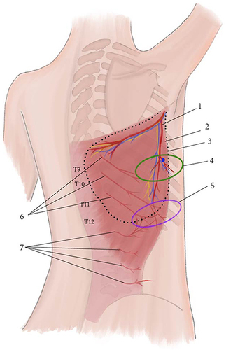 Figure 1 A schematic illustration of traditional LDMF, TAPcp flap and low skin paddle pedicled LDMF. 1, Thoracodorsal artery. 2, latissimus dorsi muscle. 3, Traditional LDMF. 4, TAPcp flap. 5, Low skin paddle pedicled LDMF. 6, Perforating branches of the 9th, 10th and 11th intercostal artery. 7, Perforating branches of the lumbar arteries. Blue circle, the perforator of descending branch of the thoracodorsal artery.