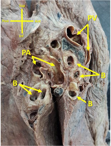Figure 1 Novel pulmonary artery located posterior to bronchus in left lung.