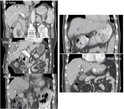 Figure 2 Examples of coronal CT images showing clips located in different lobes of the liver.